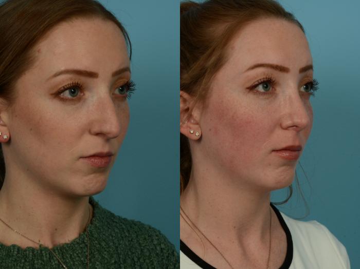 Before & After Rhinoplasty by Dr. Sinno Case 1153 Right Oblique View in Chicago, IL