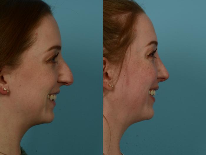 Before & After Rhinoplasty by Dr. Sinno Case 1153 Right Side View in Chicago, IL