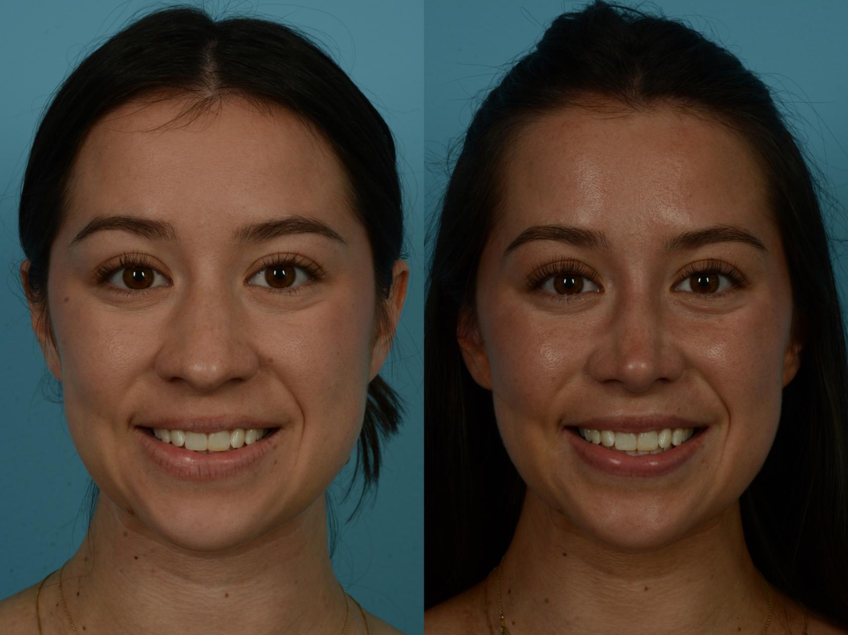 Before & After Rhinoplasty by Dr. Sinno Case 1155 Front View in Chicago, IL