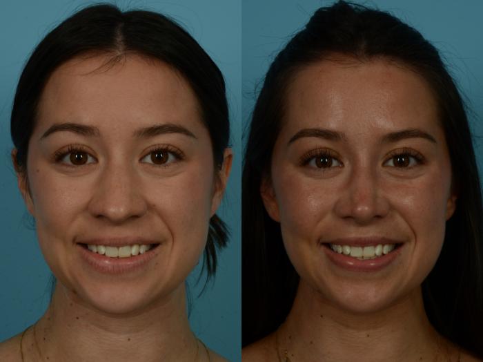 Before & After Rhinoplasty by Dr. Sinno Case 1155 Front View in Chicago, IL