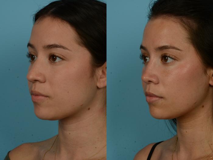 Before & After Rhinoplasty by Dr. Sinno Case 1155 Left Oblique View in Chicago, IL