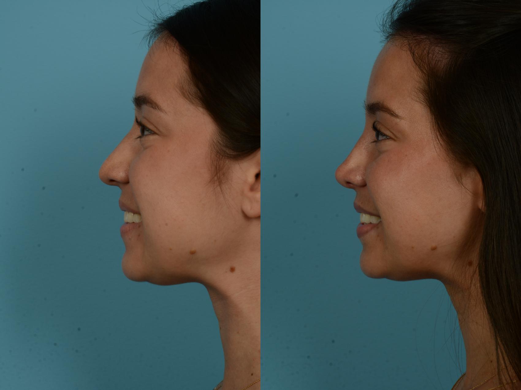 Before & After Rhinoplasty by Dr. Sinno Case 1155 Left Side View in Chicago, IL