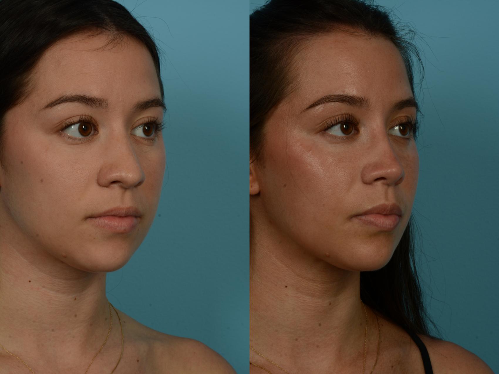 Before & After Rhinoplasty by Dr. Sinno Case 1155 Right Oblique View in Chicago, IL