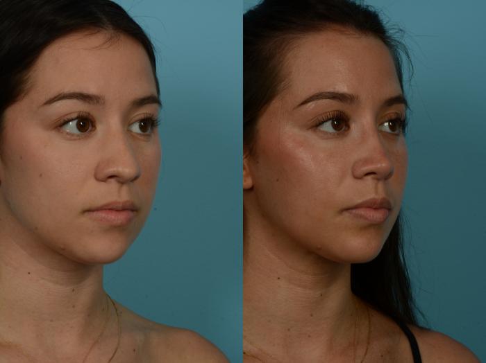 Before & After Rhinoplasty by Dr. Sinno Case 1155 Right Oblique View in Chicago, IL
