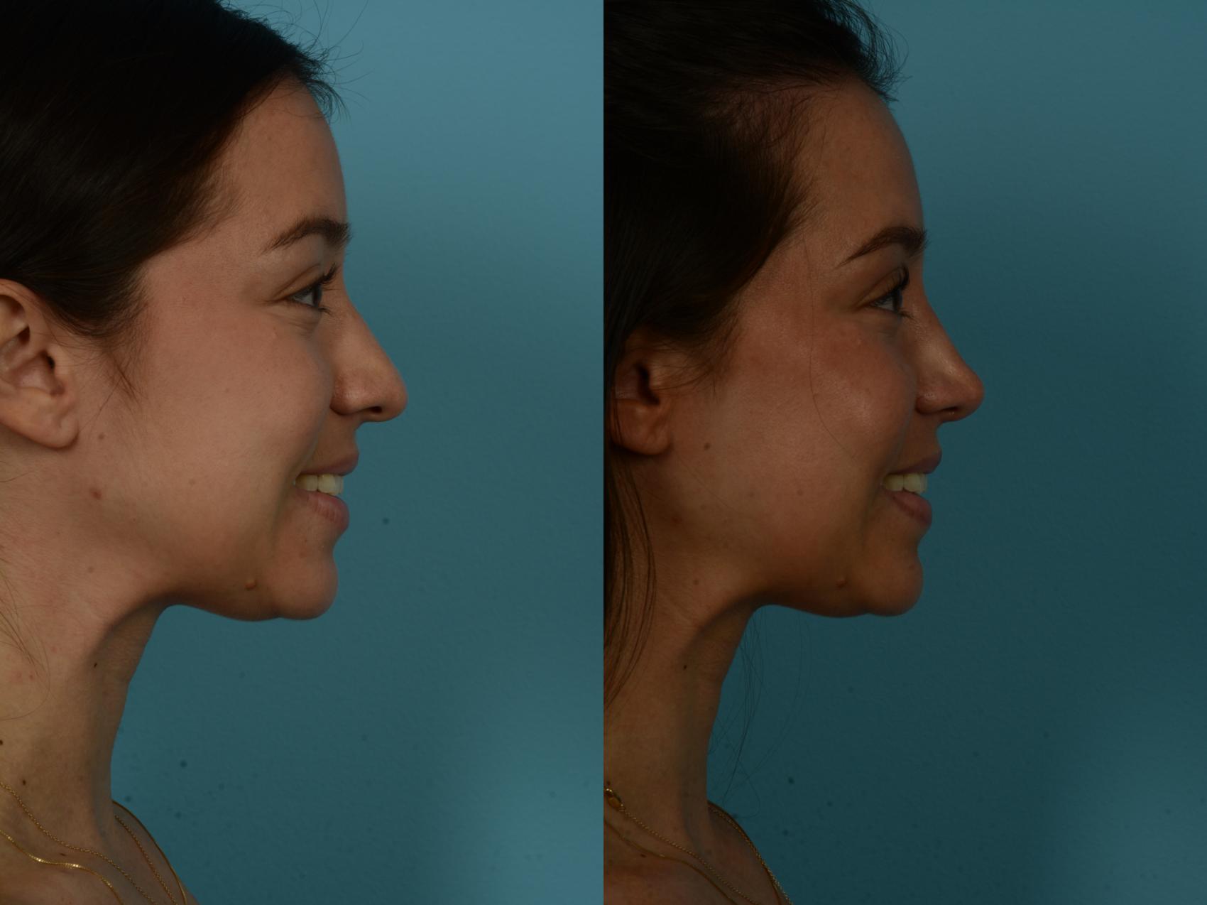 Before & After Rhinoplasty by Dr. Sinno Case 1155 Right Side View in Chicago, IL