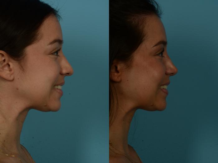 Before & After Rhinoplasty by Dr. Sinno Case 1155 Right Side View in Chicago, IL