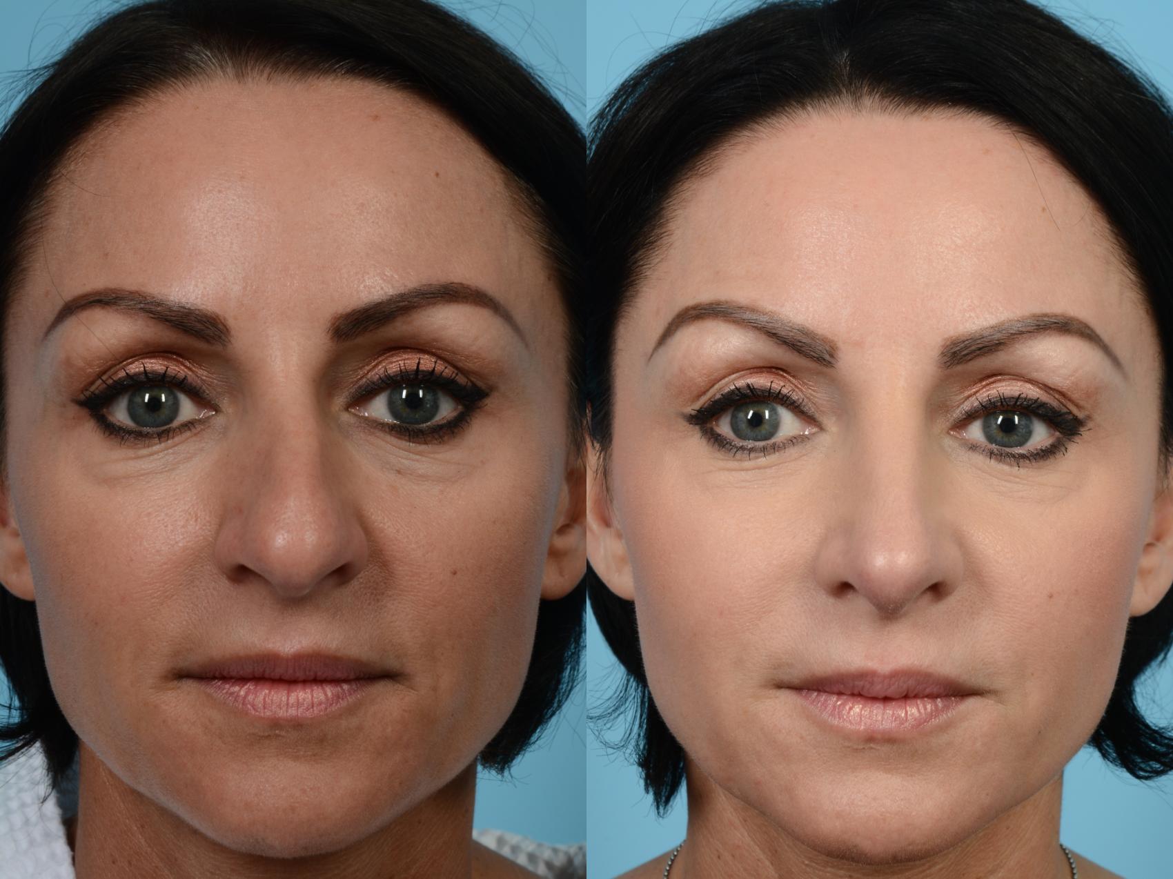 Dr. Sinno Rhinoplasty in Chicago, Illinois