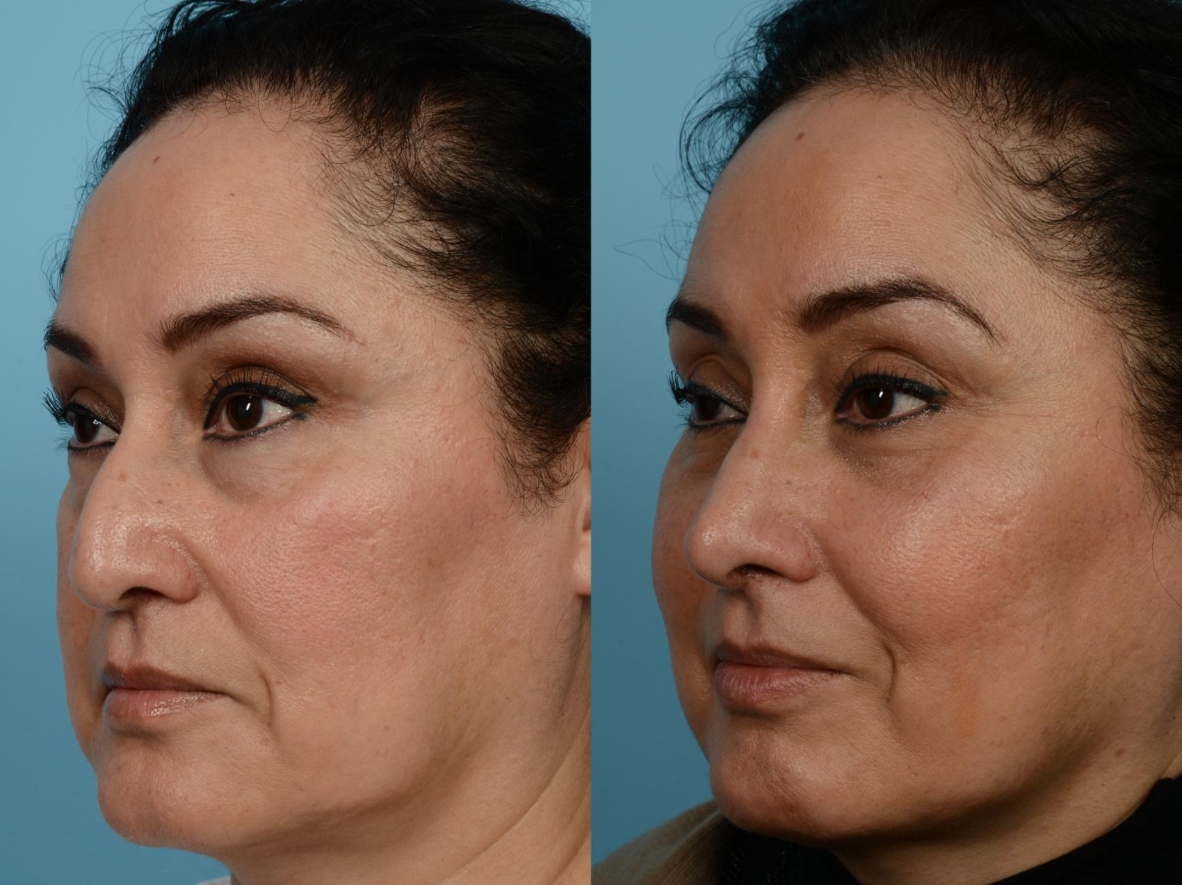Dr. Sinno Rhinoplasty in Chicago, Illinois