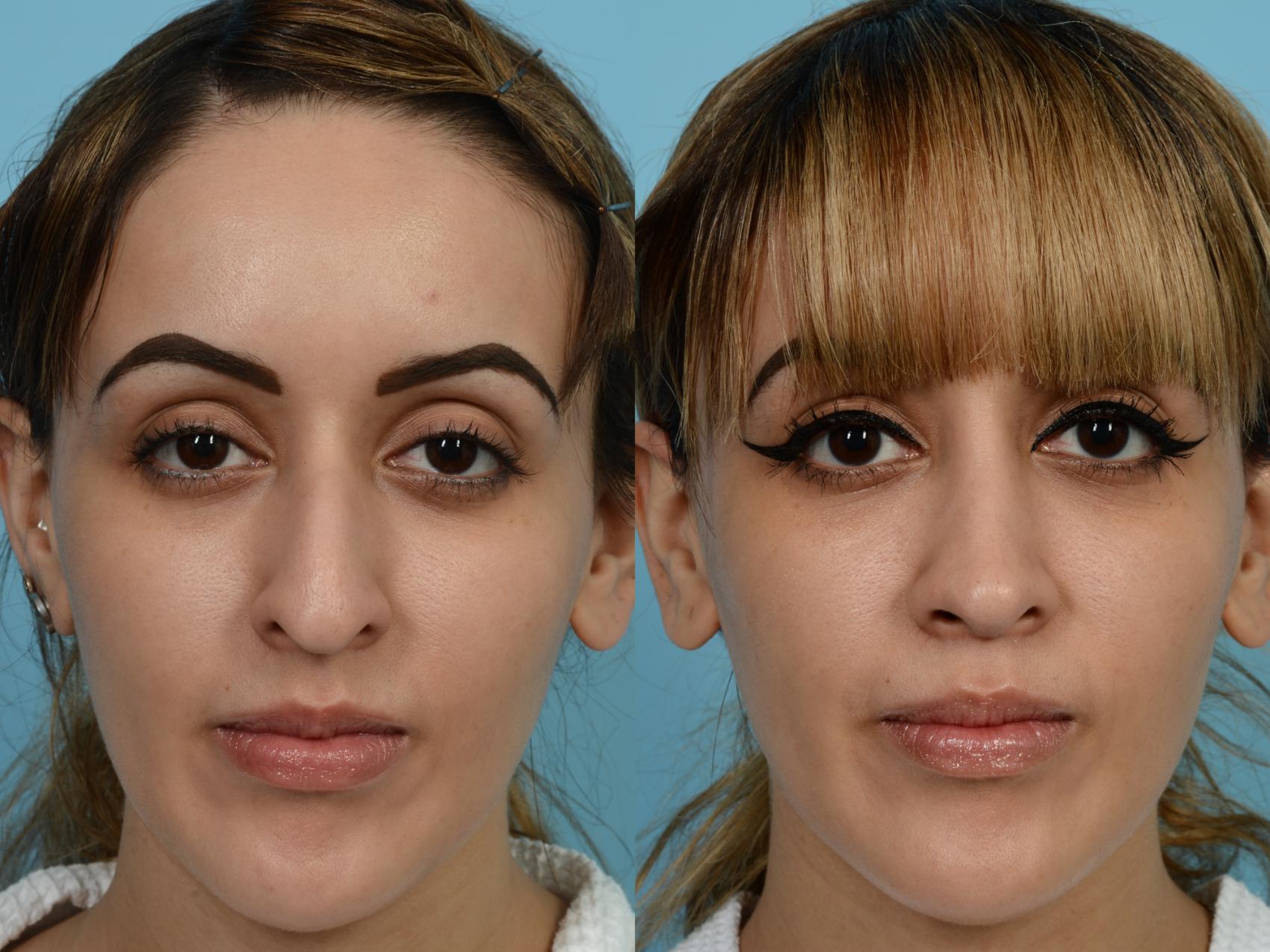 Dr. Sinno Rhinoplasty in Chicago, Illinois