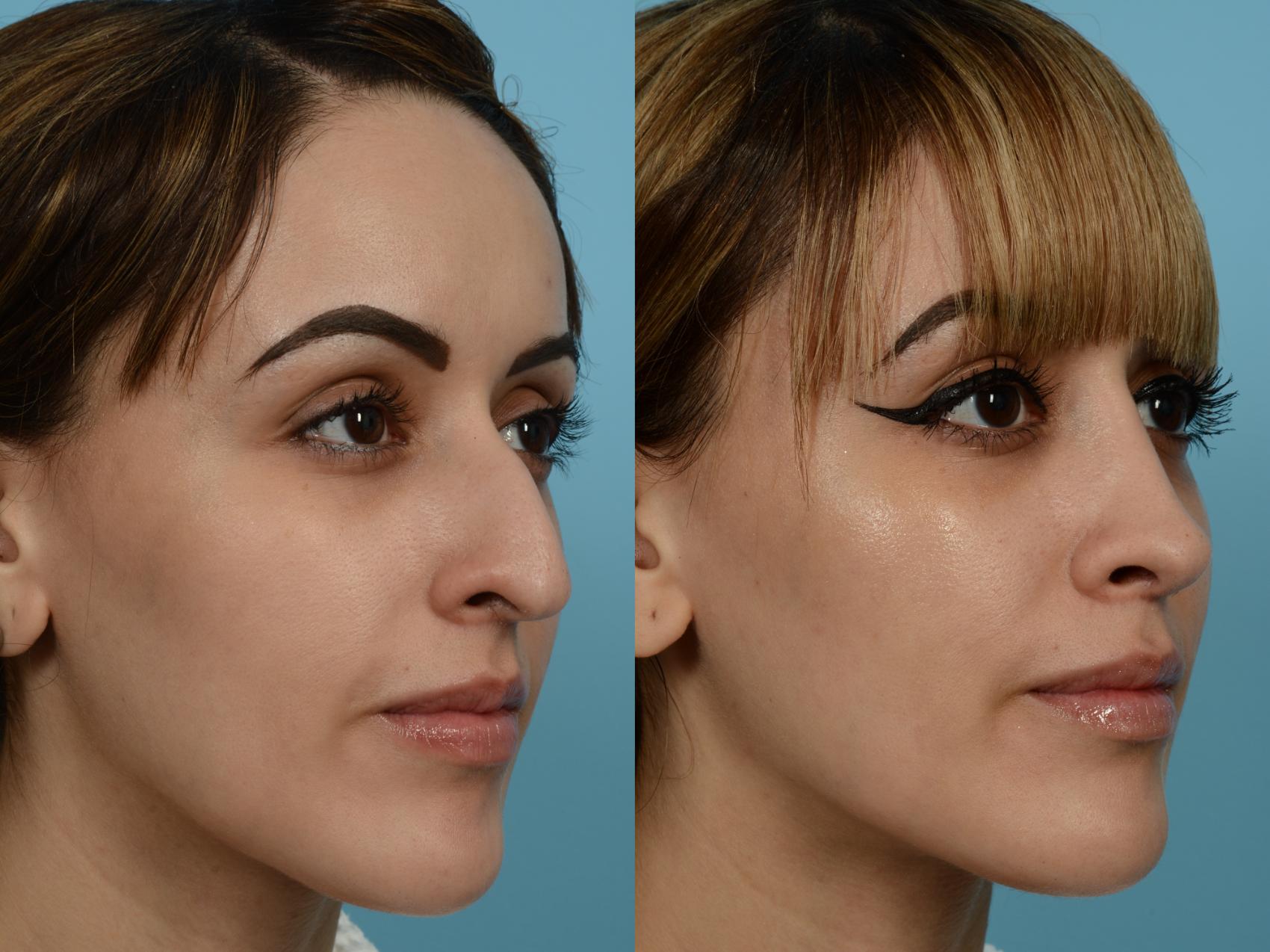 Dr. Sinno Rhinoplasty in Chicago, Illinois
