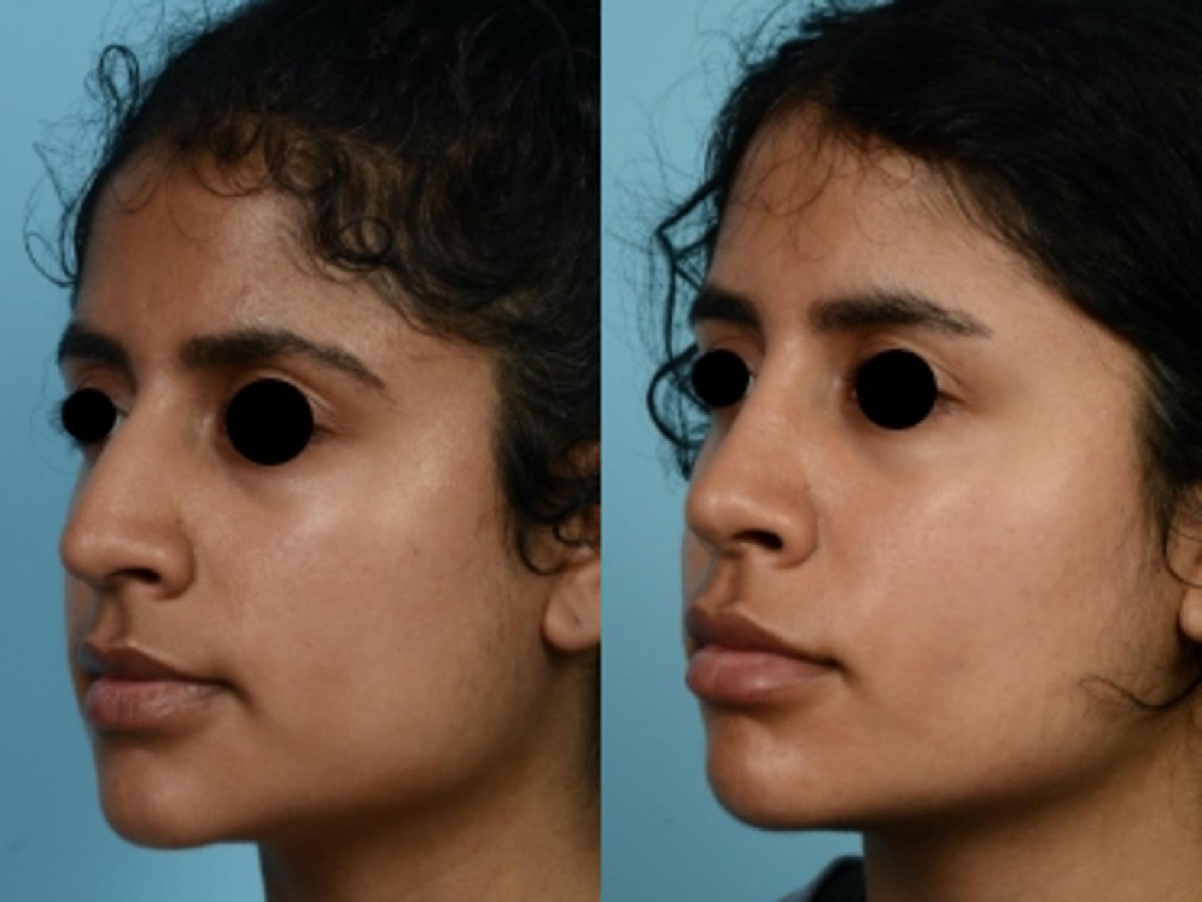 Dr. Sinno Rhinoplasty in Chicago, Illinois