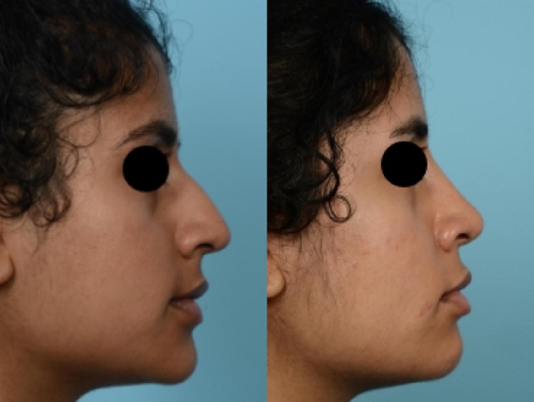 Dr. Sinno Rhinoplasty in Chicago, Illinois