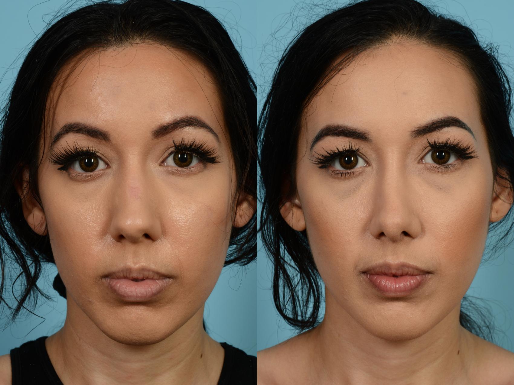 Dr. Sinno Rhinoplasty in Chicago, Illinois