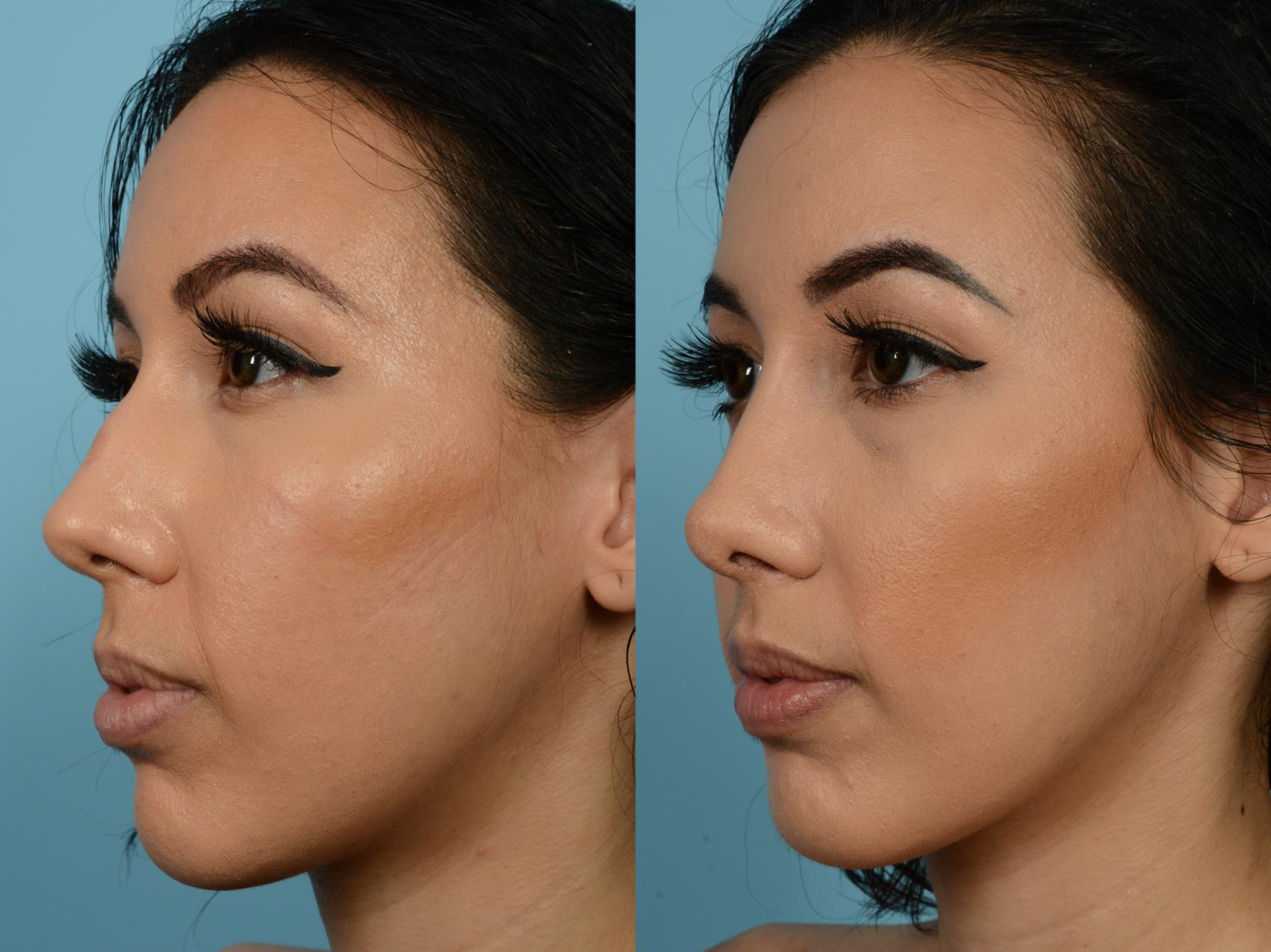 Dr. Sinno Rhinoplasty in Chicago, Illinois