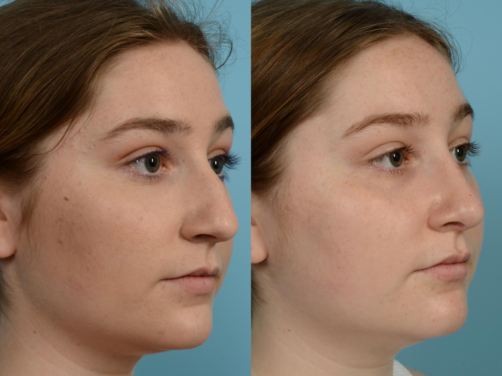 Dr. Sinno Rhinoplasty in Chicago, Illinois