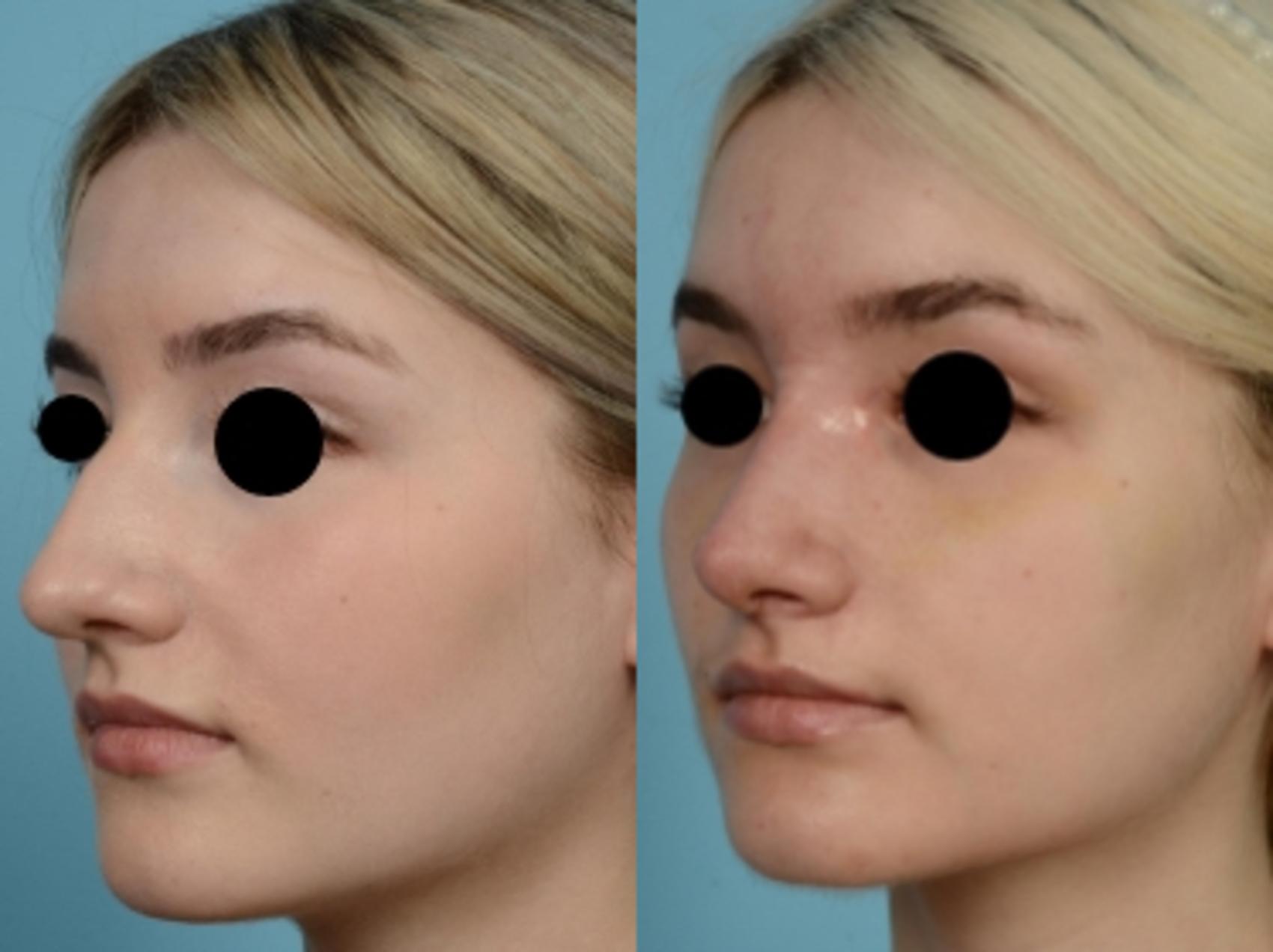 Dr. Sinno Rhinoplasty in Chicago, Illinois
