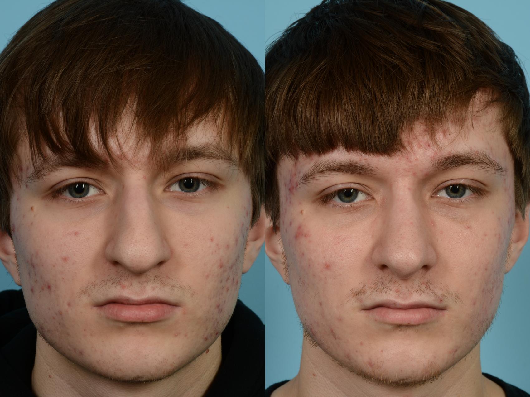 Dr. Sinno Revision Rhinoplasty in Chicago, Illinois