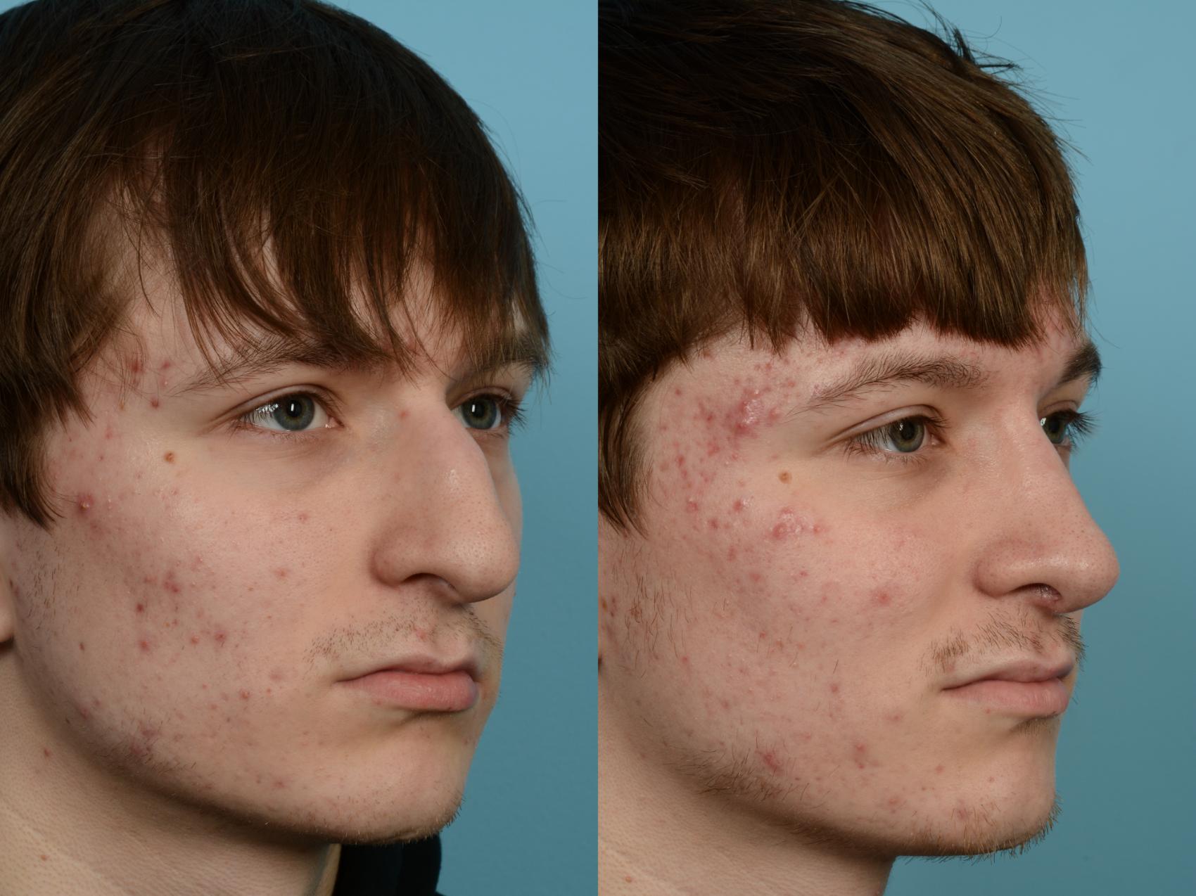 Dr. Sinno Revision Rhinoplasty in Chicago, Illinois