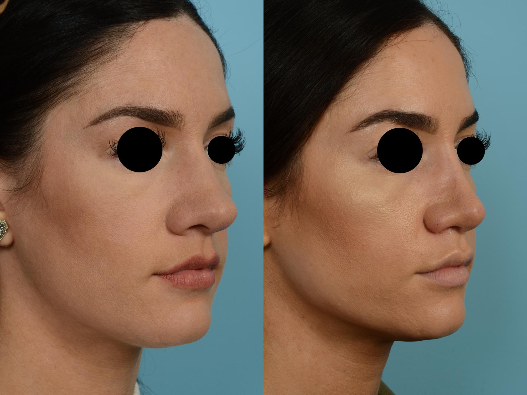 Dr. Sinno Rhinoplasty in Chicago, Illinois
