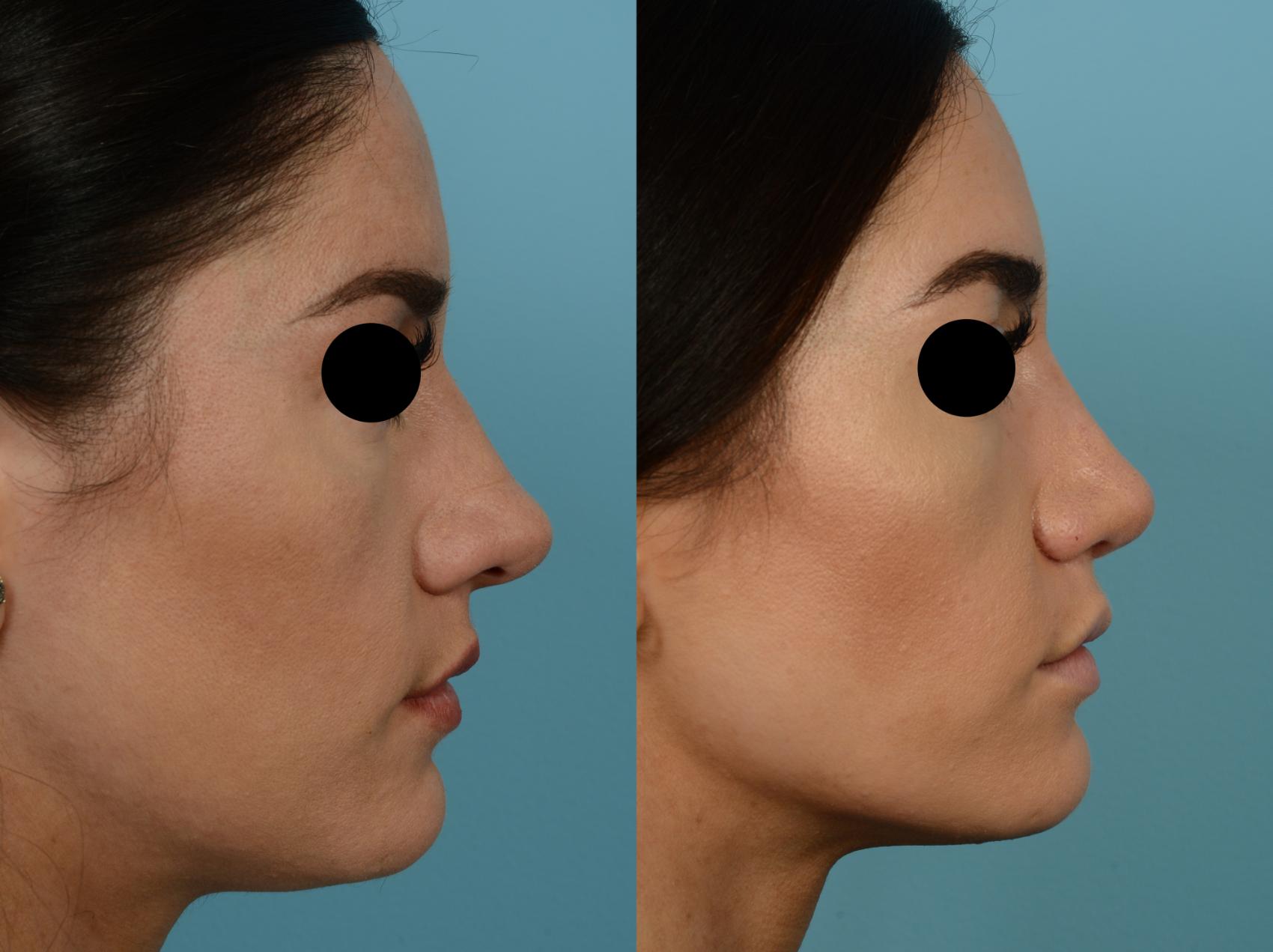 Dr. Sinno Rhinoplasty in Chicago, Illinois