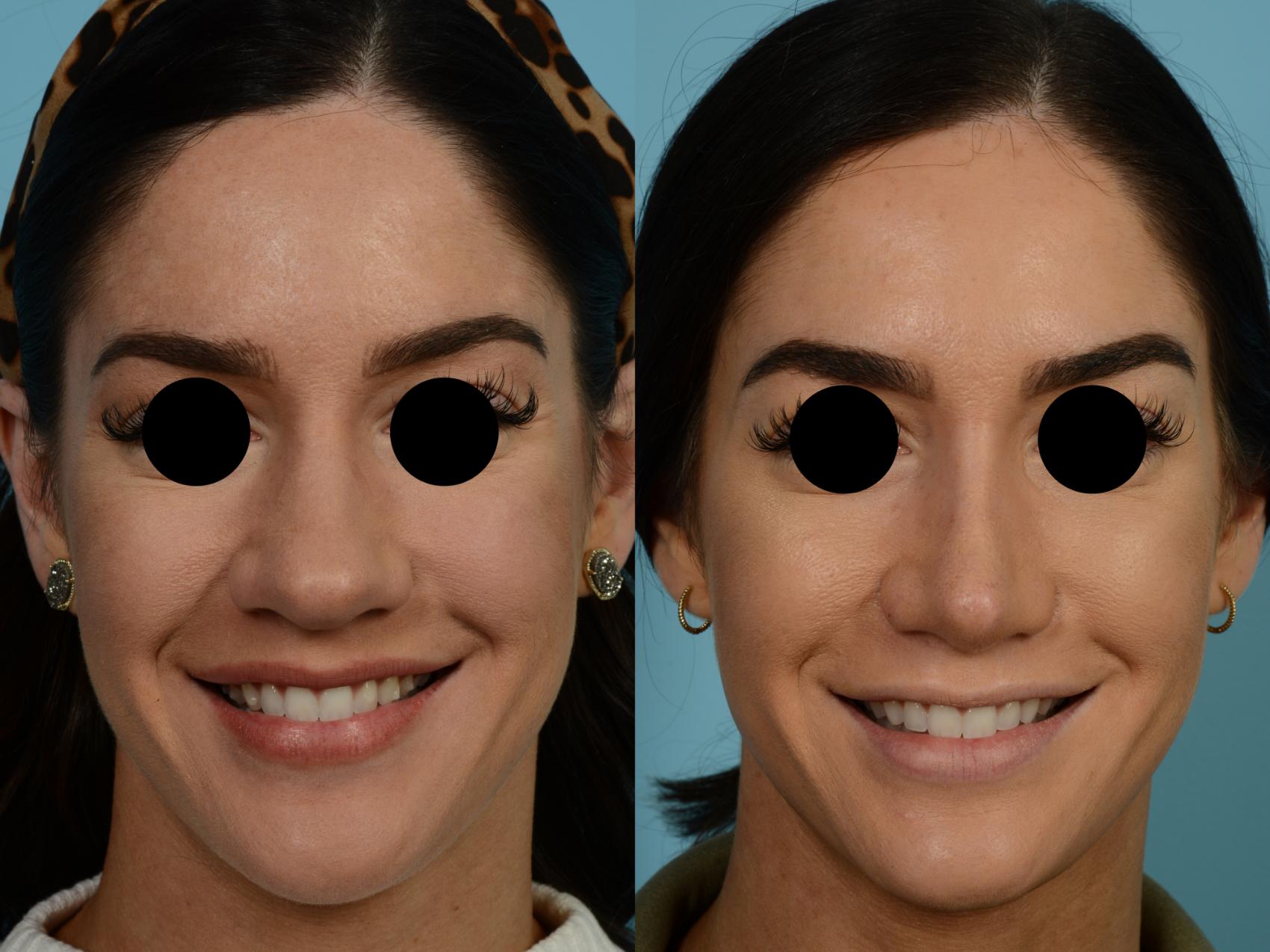 Dr. Sinno Rhinoplasty in Chicago, Illinois