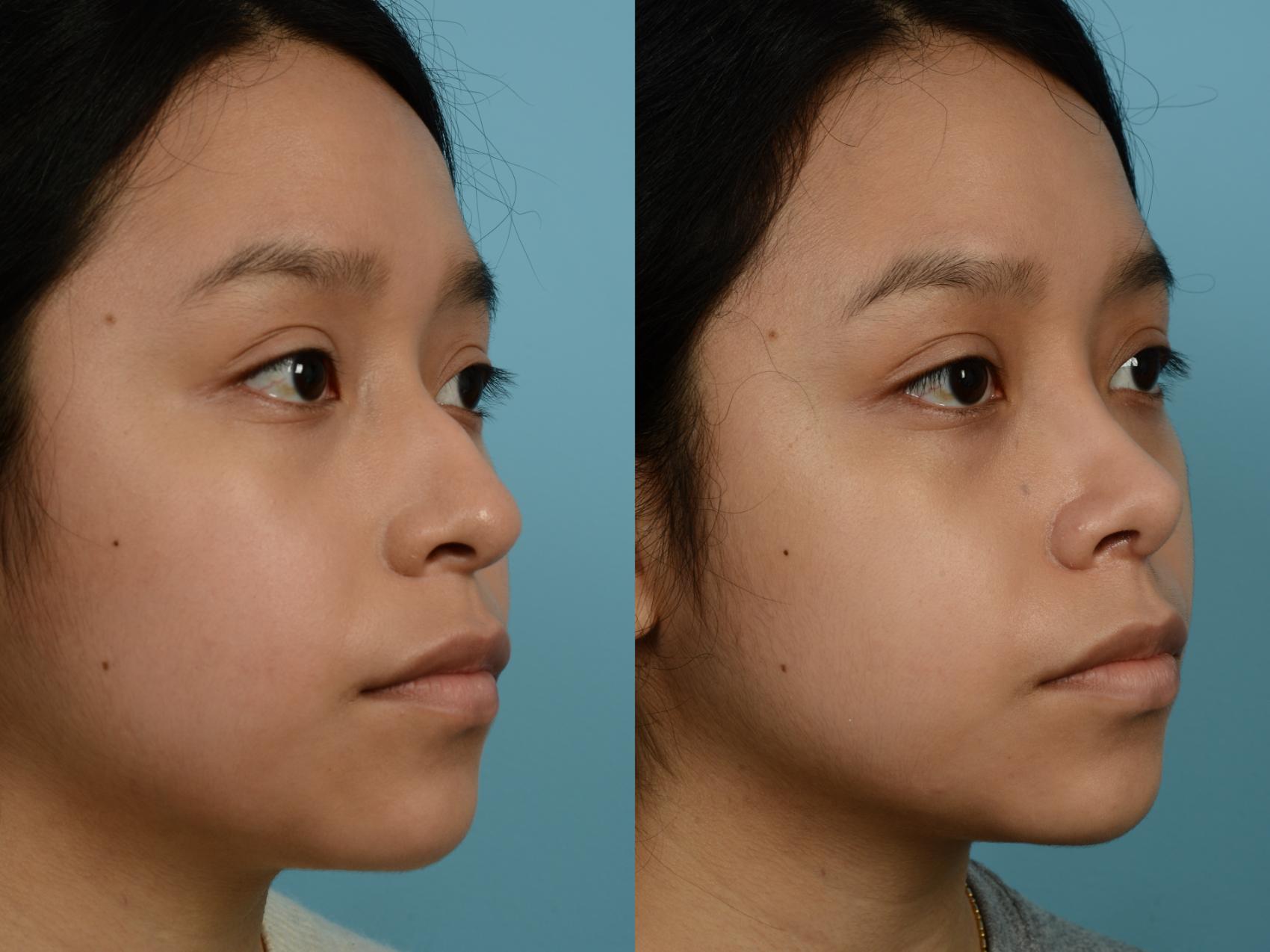 Dr. Sinno Rhinoplasty in Chicago, Illinois