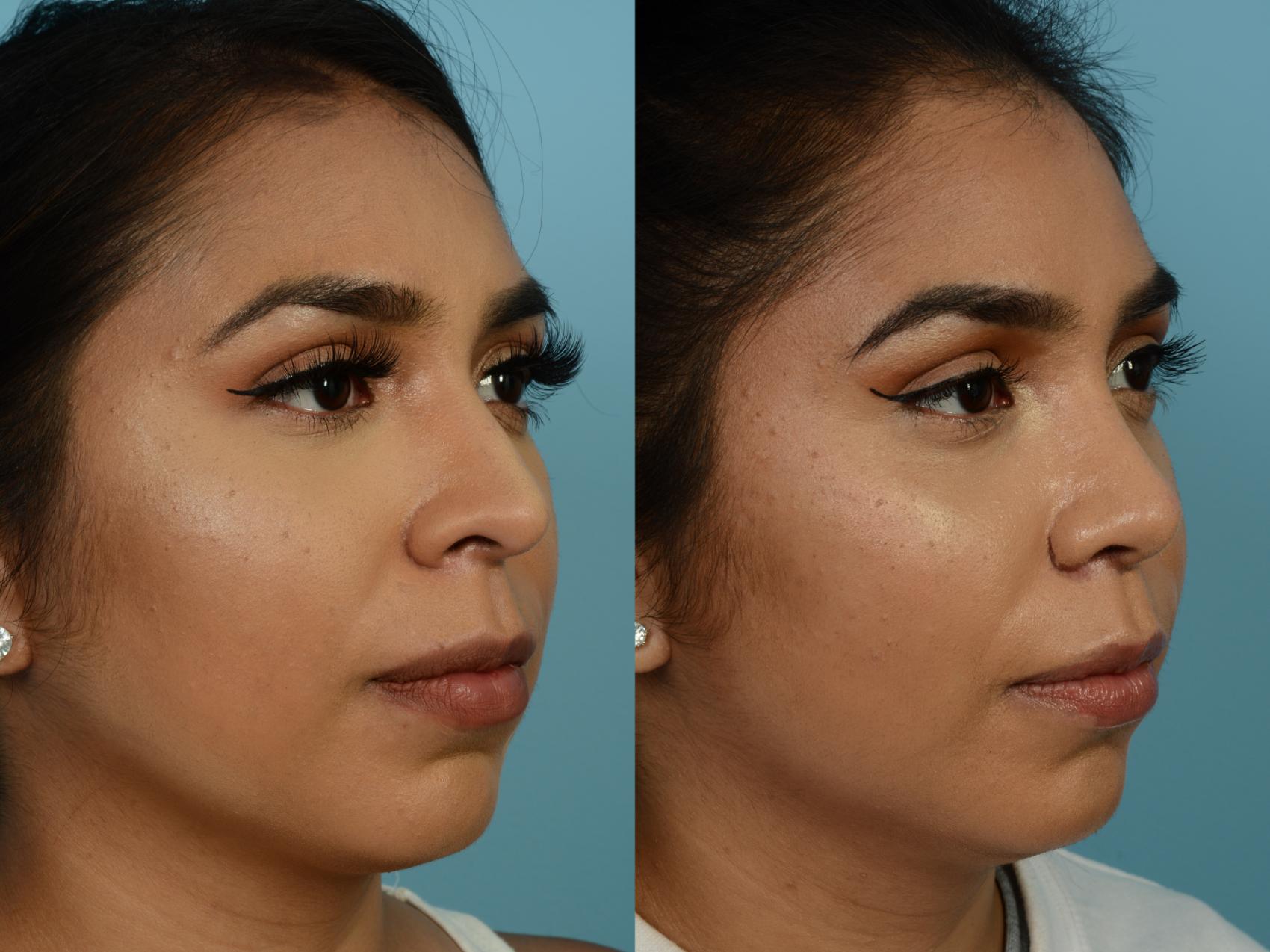 Dr. Sinno Rhinoplasty in Chicago, Illinois