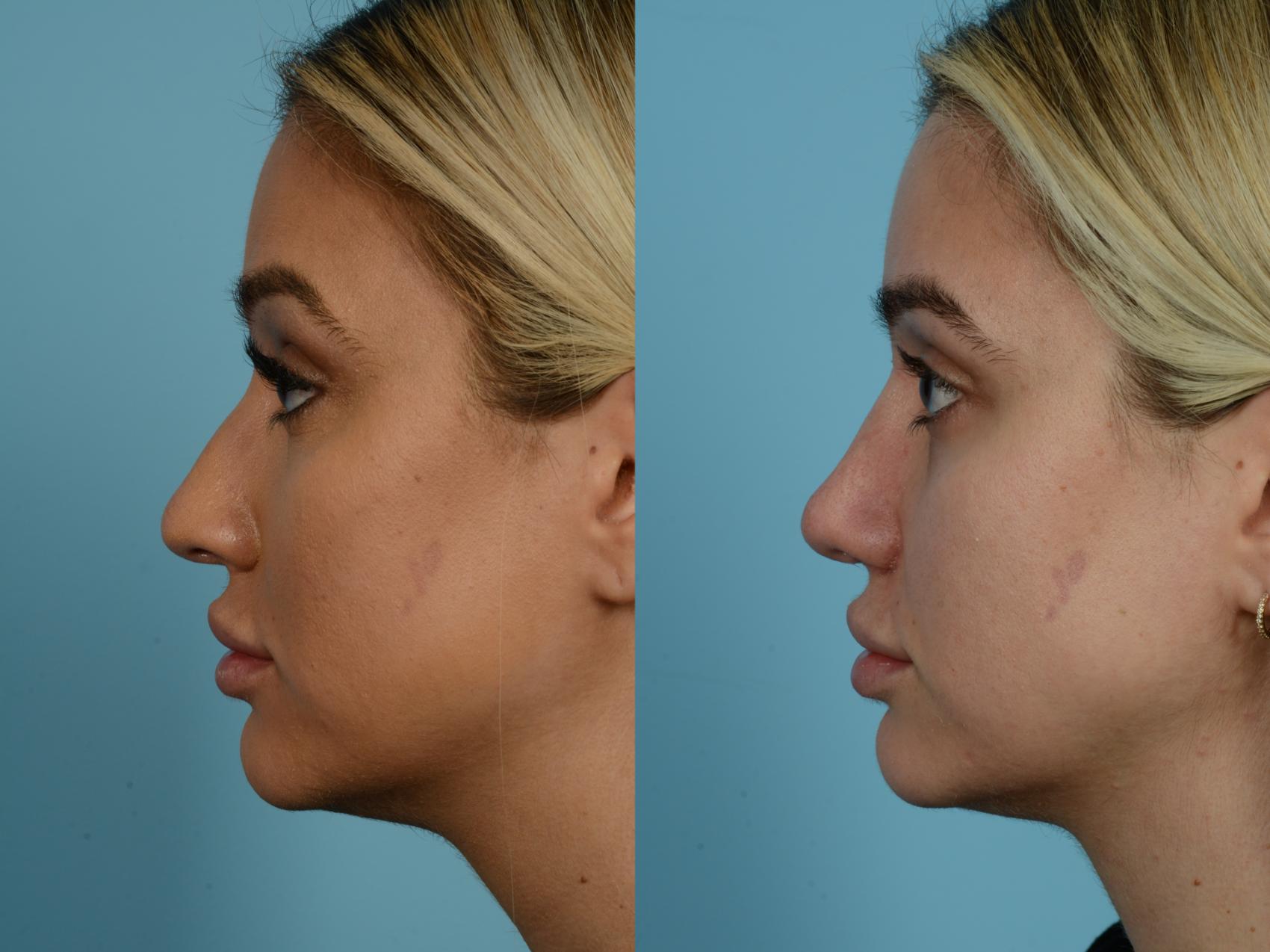 Dr. Sinno Rhinoplasty in Chicago, Illinois
