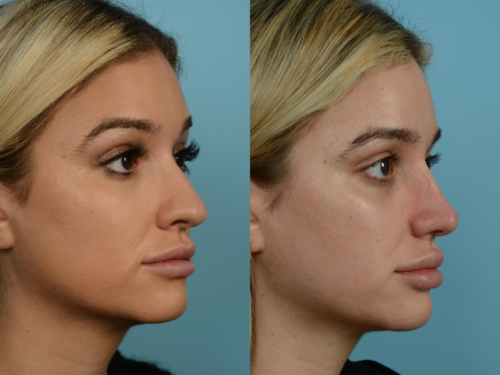 Dr. Sinno Rhinoplasty in Chicago, Illinois