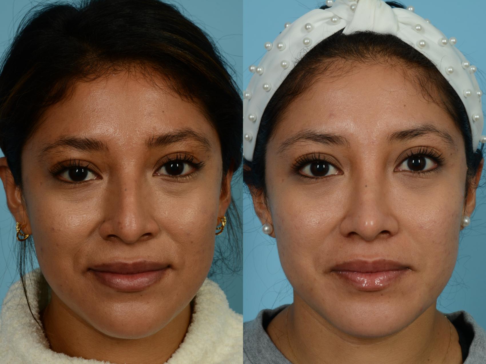 Dr. Sinno Rhinoplasty in Chicago, Illinois