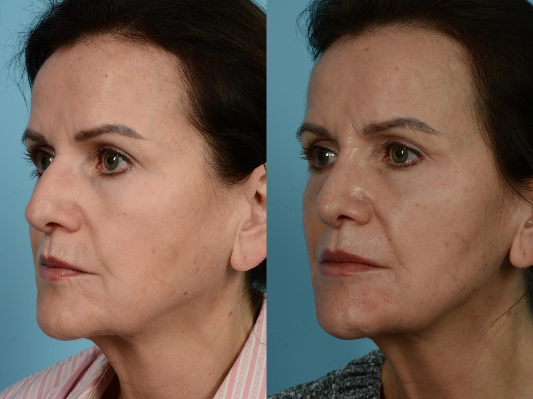 Dr. Sinno Rhinoplasty in Chicago, Illinois