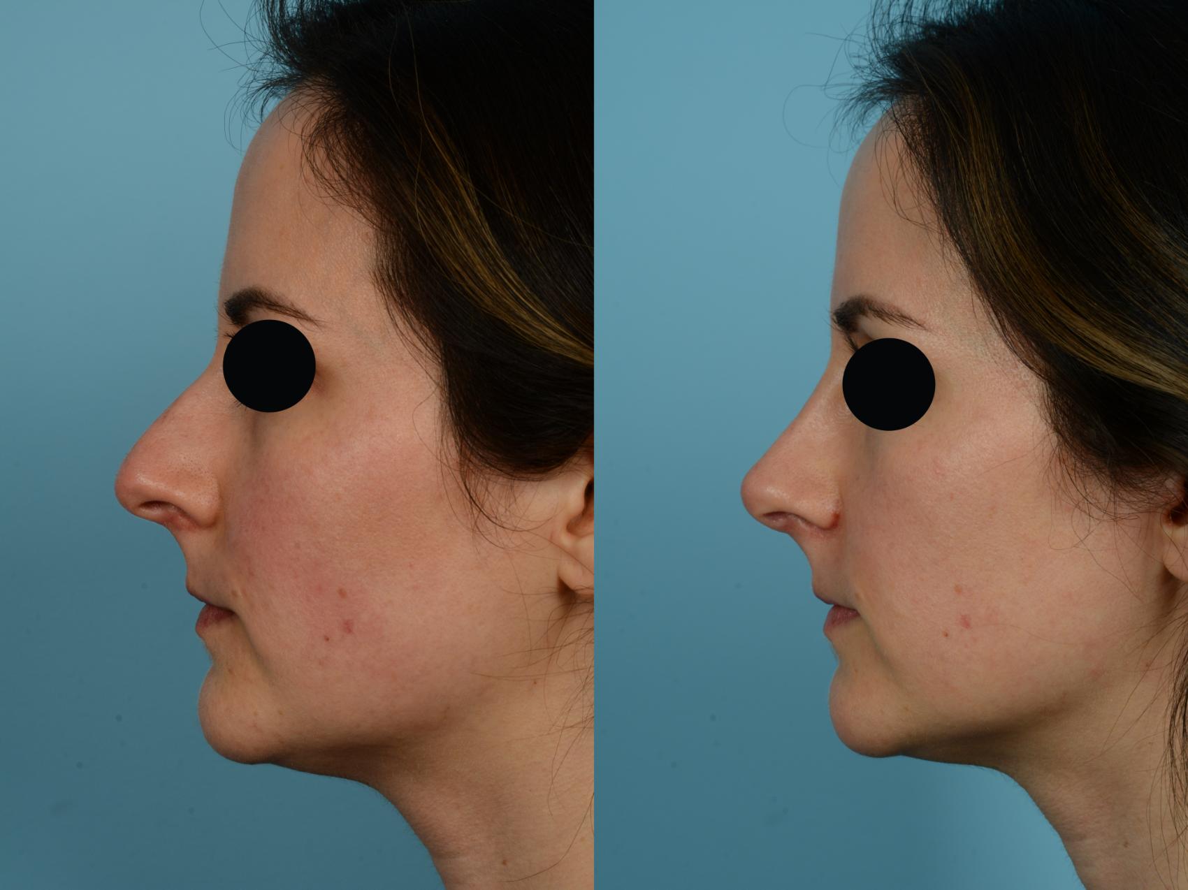 Dr. Sinno Rhinoplasty in Chicago, Illinois