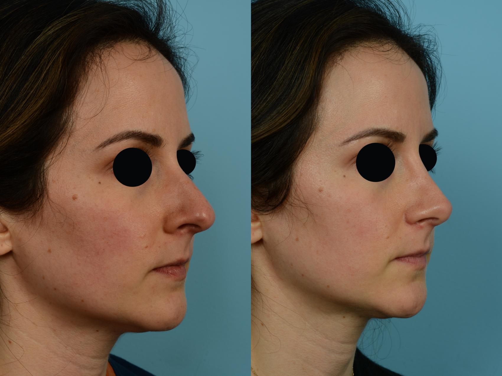 Dr. Sinno Rhinoplasty in Chicago, Illinois