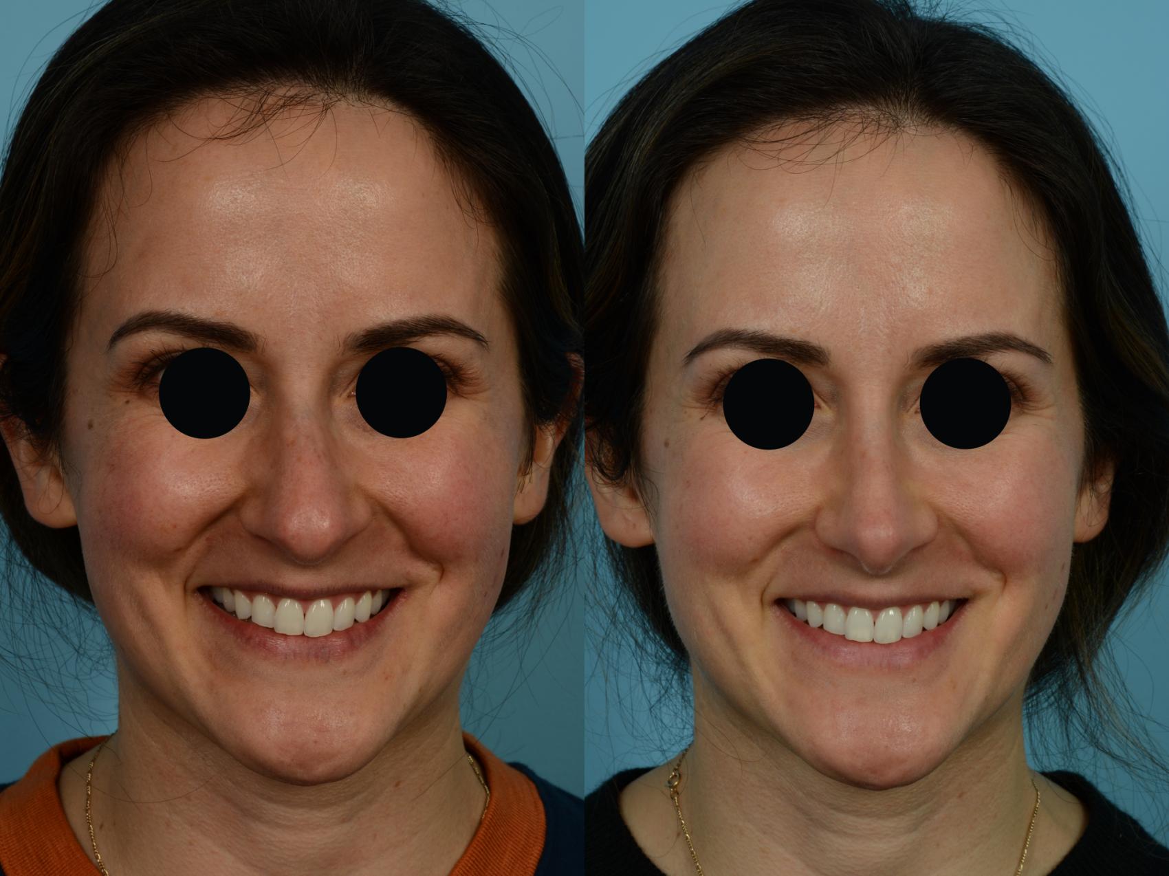 Dr. Sinno Rhinoplasty in Chicago, Illinois
