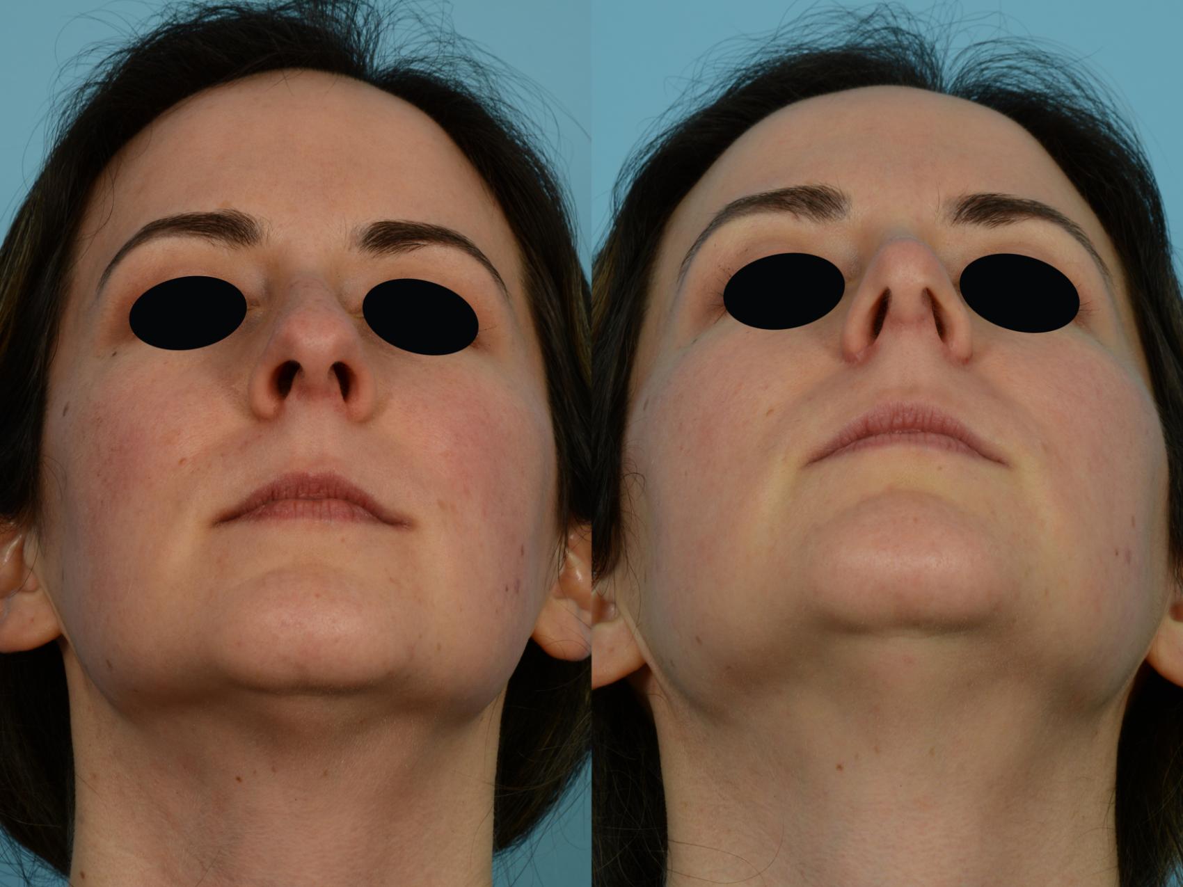 Dr. Sinno Rhinoplasty in Chicago, Illinois