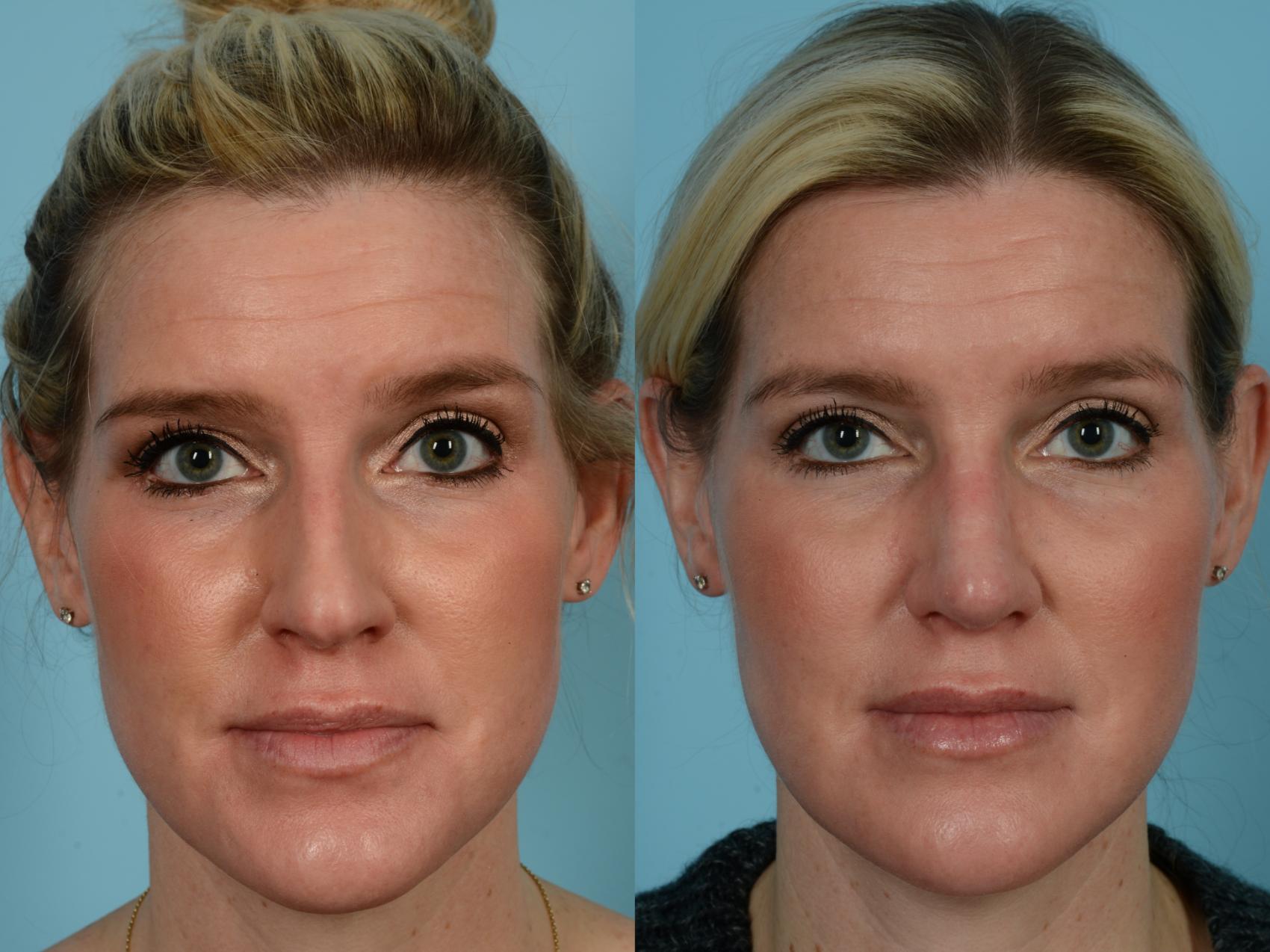 Dr. Sinno Rhinoplasty in Chicago, Illinois