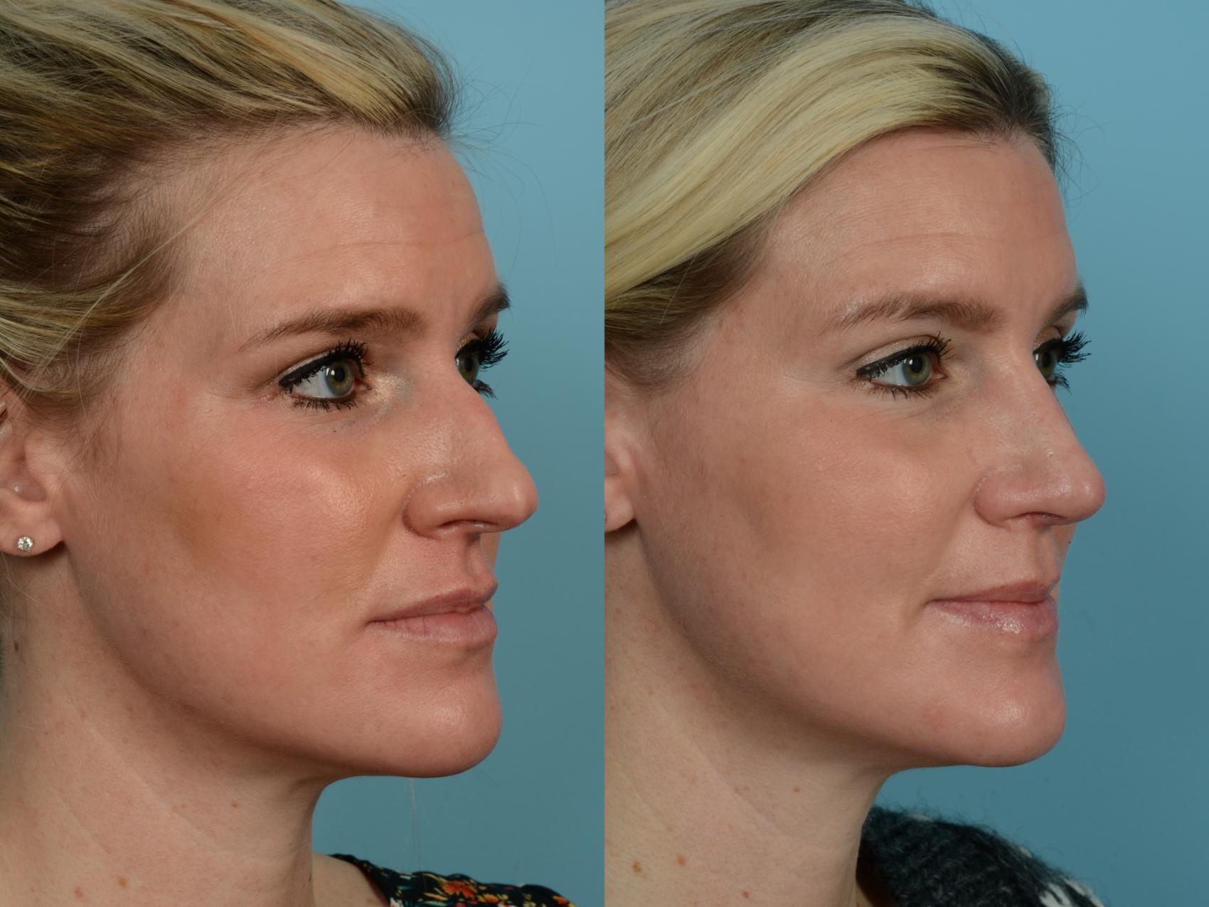 Dr. Sinno Rhinoplasty in Chicago, Illinois