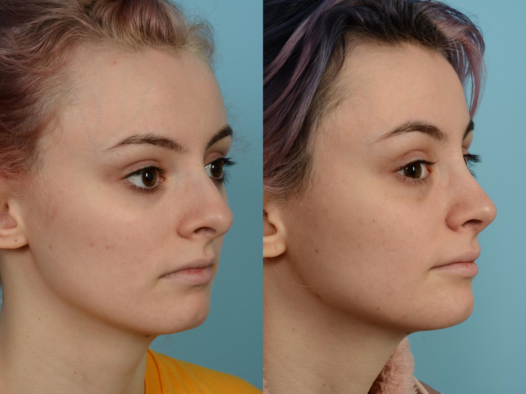 Dr. Sinno Rhinoplasty in Chicago, Illinois