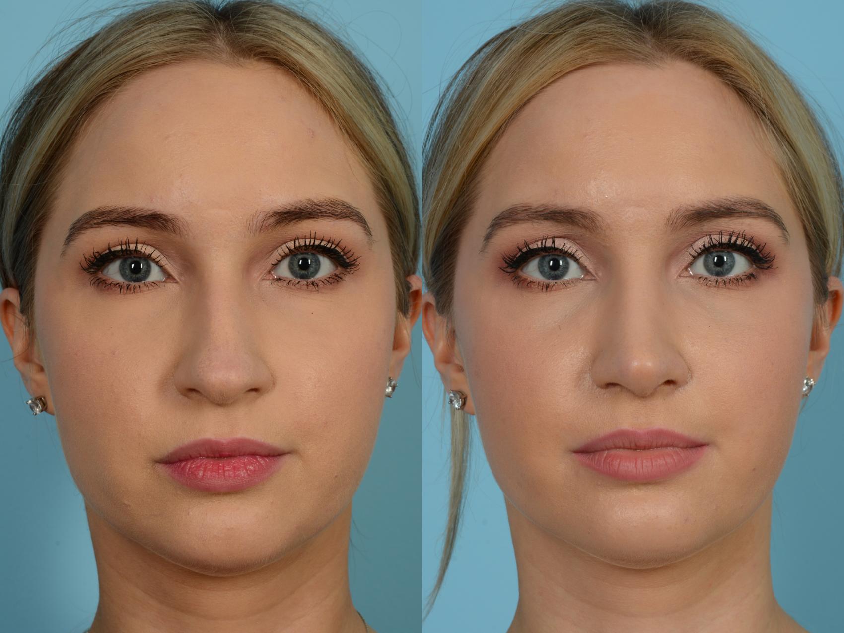 Rhinoplasty by Dr. Sinno Before and After Pictures Case 692 | Chicago ...