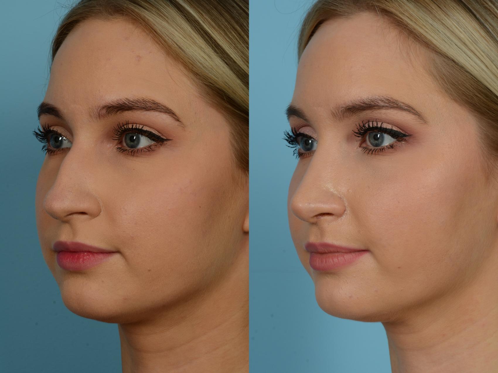 Rhinoplasty by Dr. Sinno Before and After Pictures Case 692 | Chicago ...