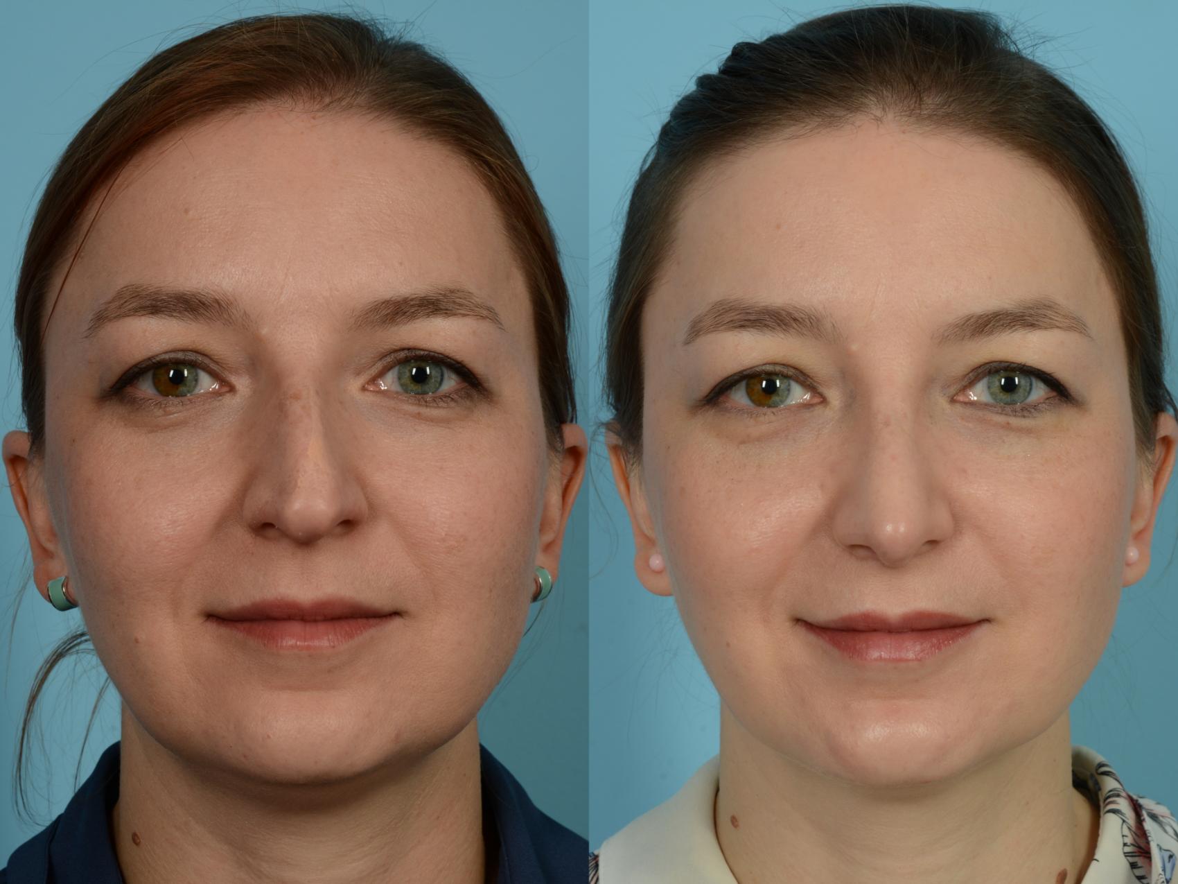 Rhinoplasty By Dr. Sinno Before And After Pictures Case 695 | Chicago ...