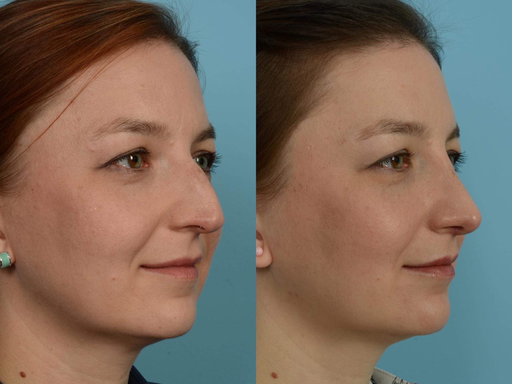 Dr. Sinno Rhinoplasty in Chicago, Illinois