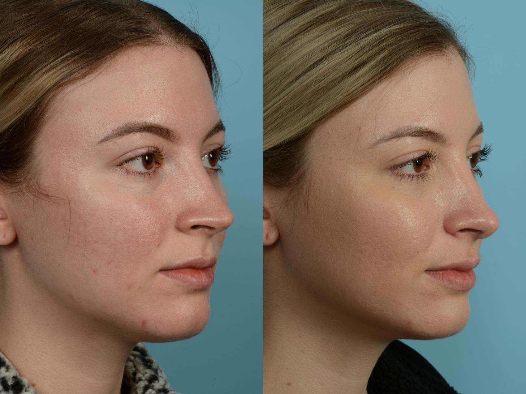 Dr. Sinno Rhinoplasty in Chicago, Illinois