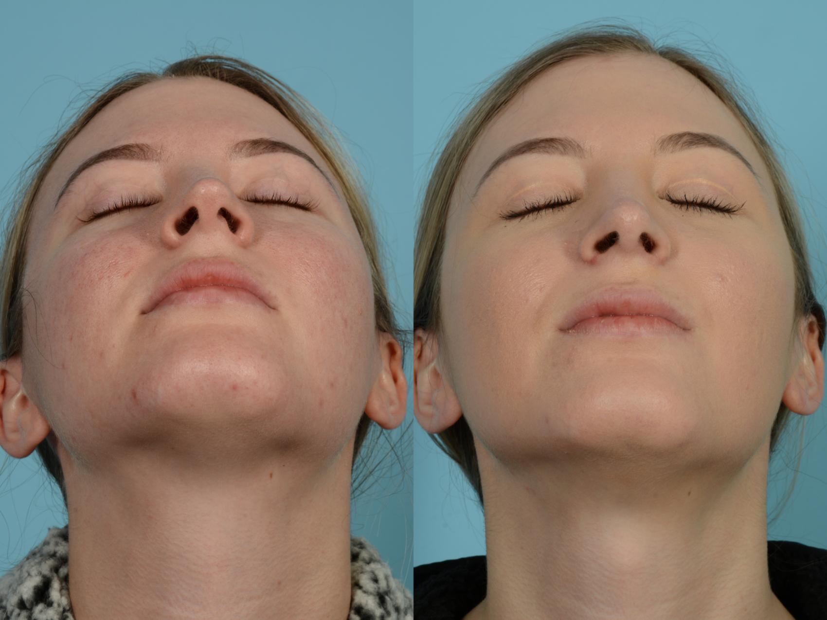 Dr. Sinno Rhinoplasty in Chicago, Illinois