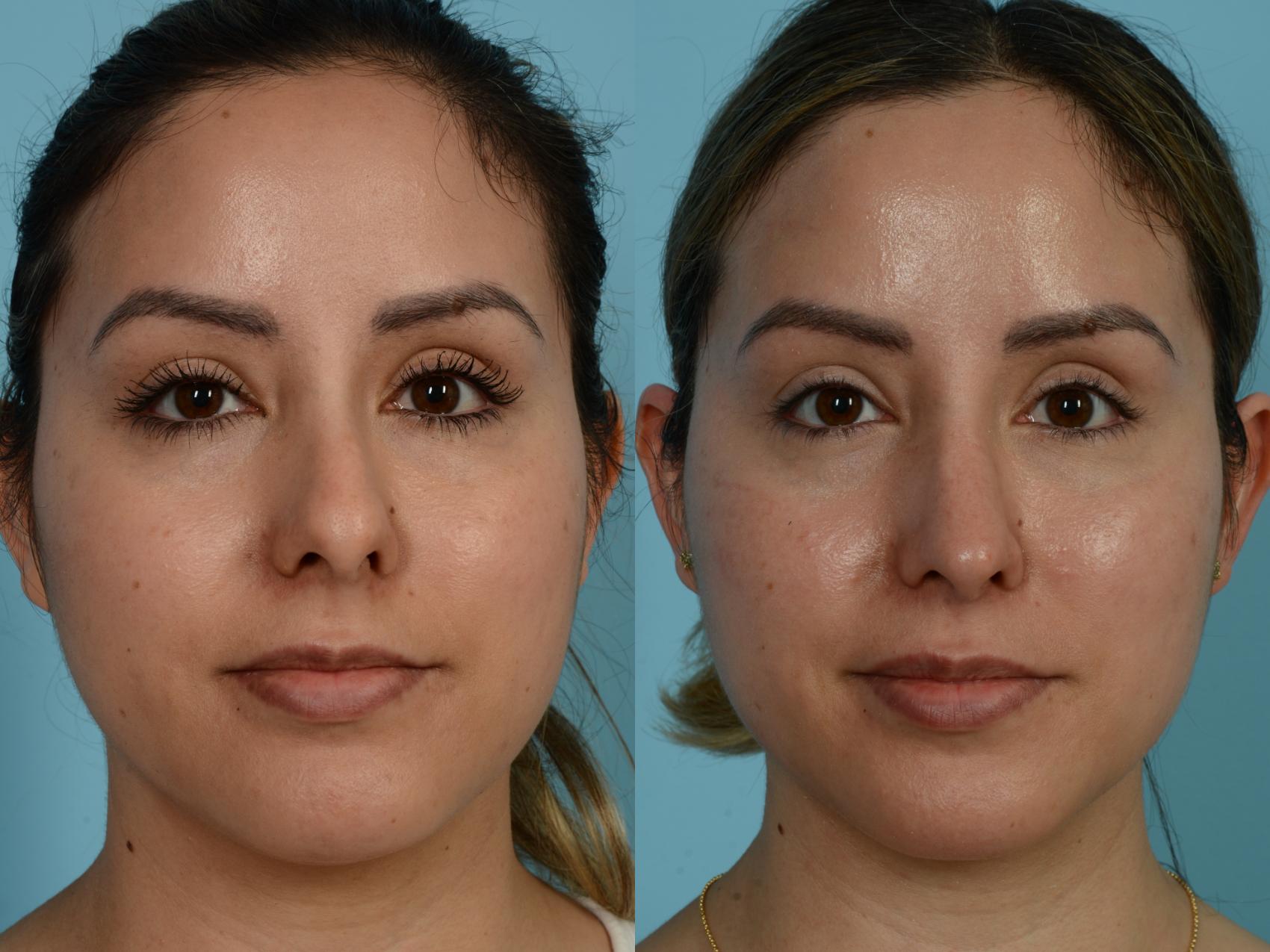 Dr. Sinno Rhinoplasty in Chicago, Illinois