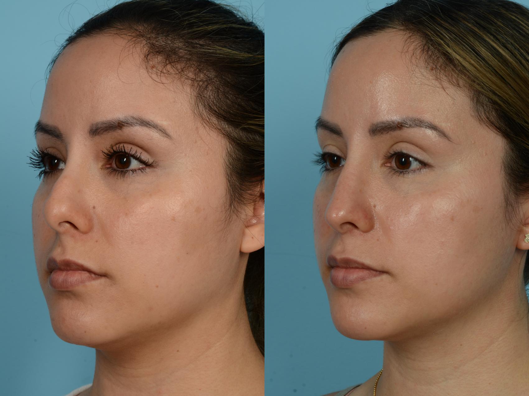 Dr. Sinno Rhinoplasty in Chicago, Illinois