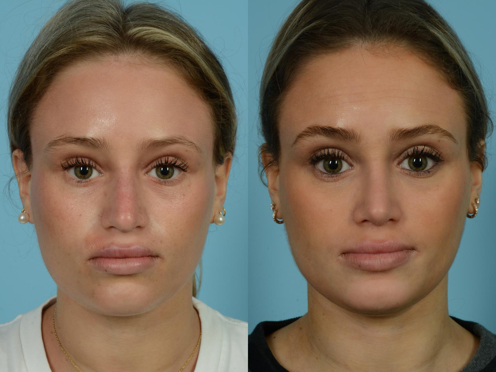 Before & After Rhinoplasty by Dr. Sinno Case 777 Front View in Chicago, IL