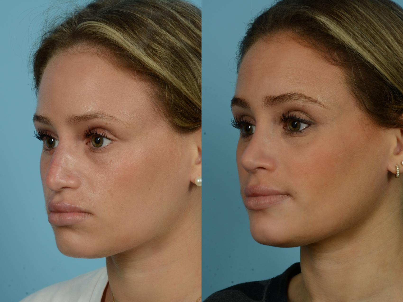Before & After Rhinoplasty by Dr. Sinno Case 777 Left Oblique View in Chicago, IL