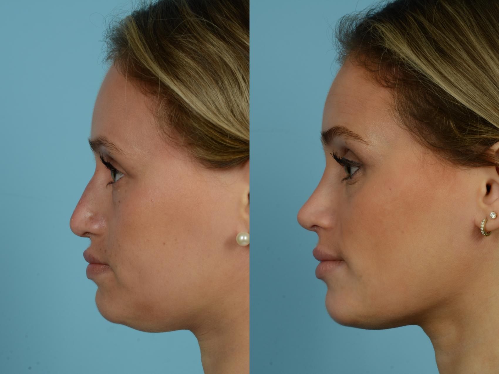 Before & After Rhinoplasty by Dr. Sinno Case 777 Left Side View in Chicago, IL