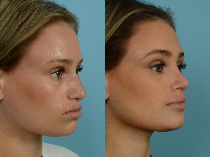 Before & After Rhinoplasty by Dr. Sinno Case 777 Right Oblique View in Chicago, IL